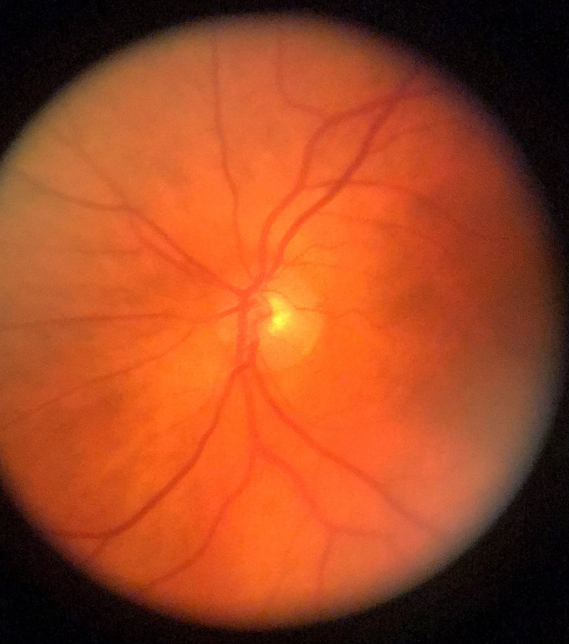 oDocs nun Ophthalmoscope – oDocs Eye Care