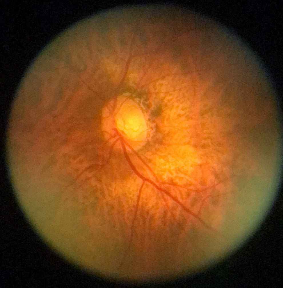 oDocs nun Ophthalmoscope – oDocs Eye Care